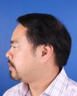 After Hair Transplant&nbsp;Front